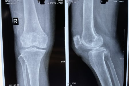 Hiếm gặp: Bệnh lý xương bánh chè hai mảnh cả hai gối