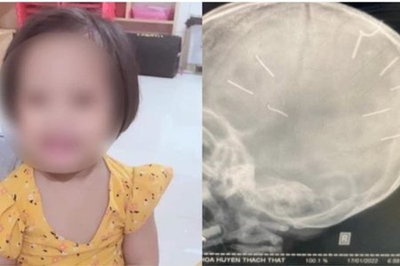 Bé gái 3 tuổi bị người tình của mẹ đóng đinh vào đầu đã tử vong
