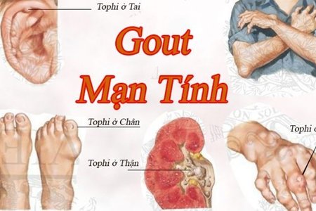 Những điều cần biết về bệnh Gout