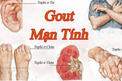 Những điều cần biết về bệnh Gout