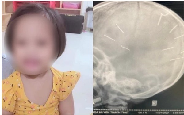 Bé 3 tuổi bị găm đinh vào đầu ở Thạch Thất đã tử vong sau gần 2 tháng nhập viện